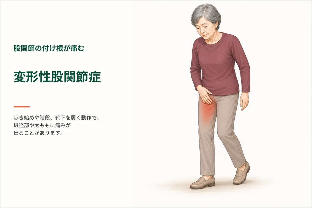 歩き始めに脚の付け根の痛みを感じる女性のイラスト