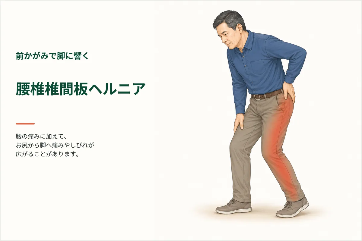 前かがみで脚まで響く｜腰椎椎間板ヘルニアで受診を急ぎたい変化のイメージ