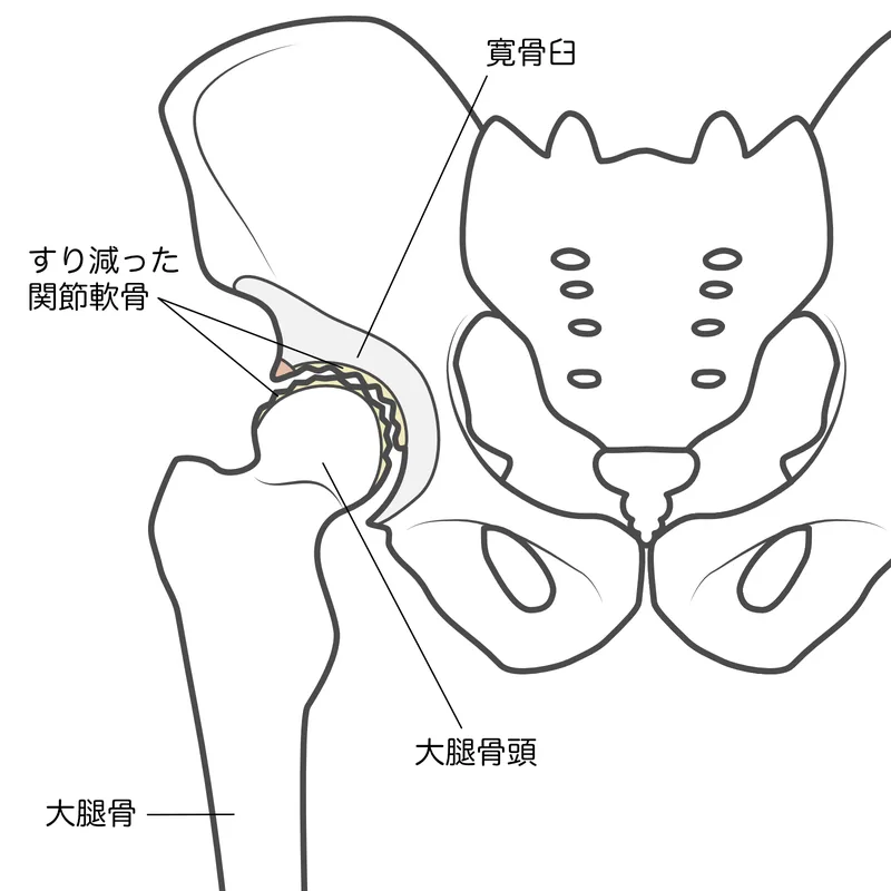 変形性股関節症の股関節構造