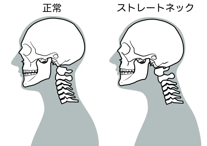 正常な首とストレートネックの比較