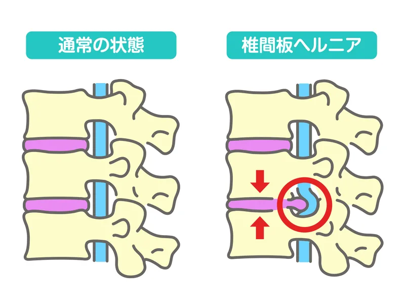 腰椎椎間板ヘルニアと脊柱管狭窄症の違いを示す図