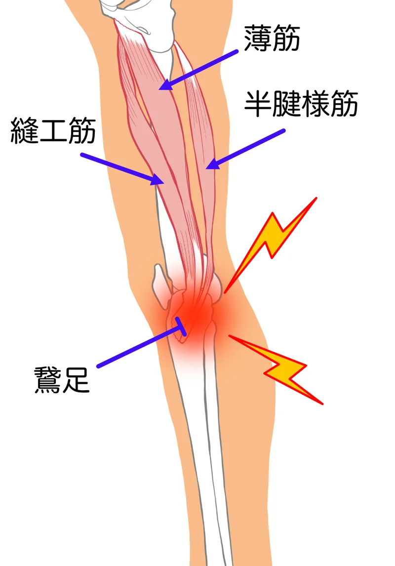鵞足炎の痛みと下肢への負担を示すイラスト