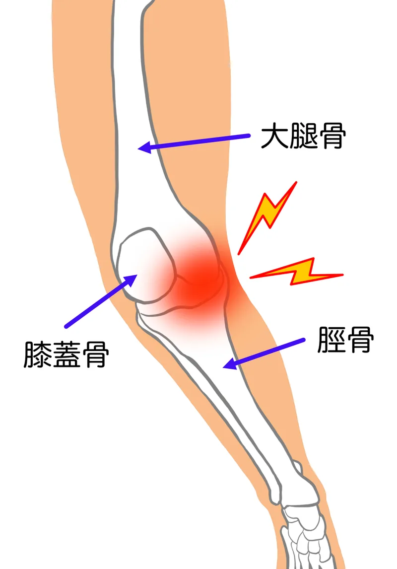 膝関節の内側周辺に痛みが出る位置を示したイラスト