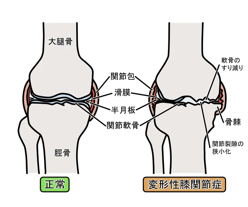 正常な膝関節と変形性膝関節症の比較
