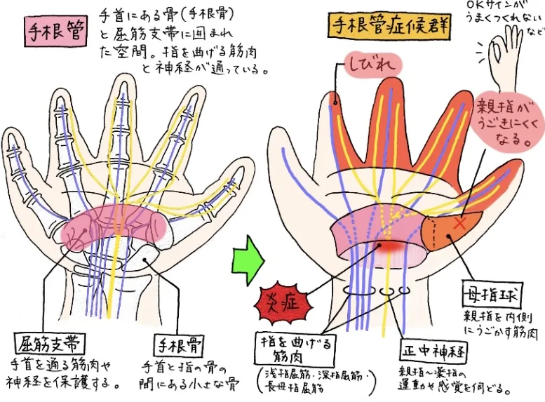 手根管症候群と腱鞘炎の比較
