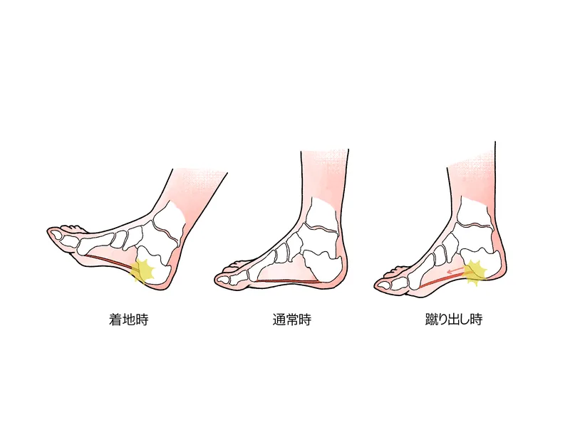 足底筋膜炎でかかとが痛いときに見直したい足裏アーチと歩き方
