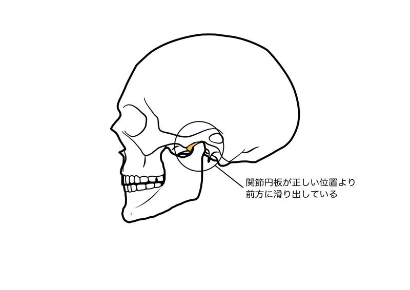 顎関節と頭蓋骨、口を動かす位置関係を示したイラスト