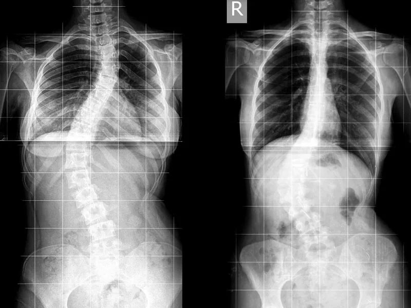 側弯症の背骨レントゲン画像